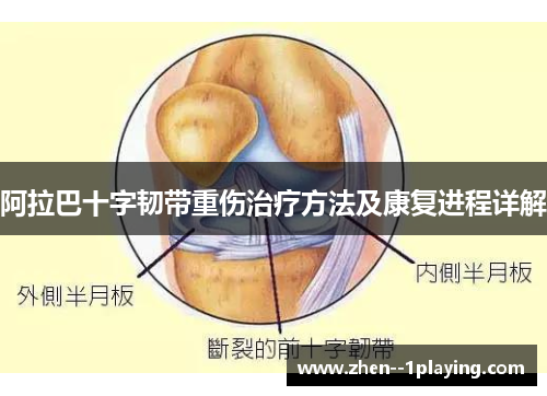 阿拉巴十字韧带重伤治疗方法及康复进程详解